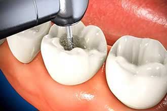 Root Canal Treatment