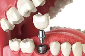 Dental Implants