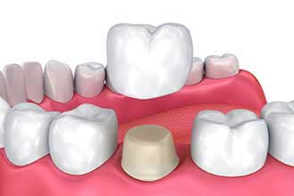 Metal Free Crowns