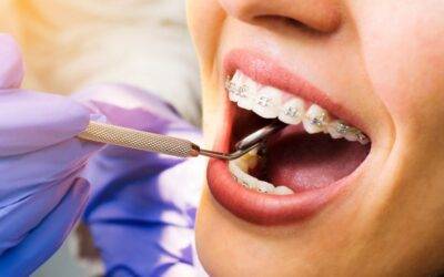 Dental Braces and It’s types, Braces cost and braces treatment in Houston