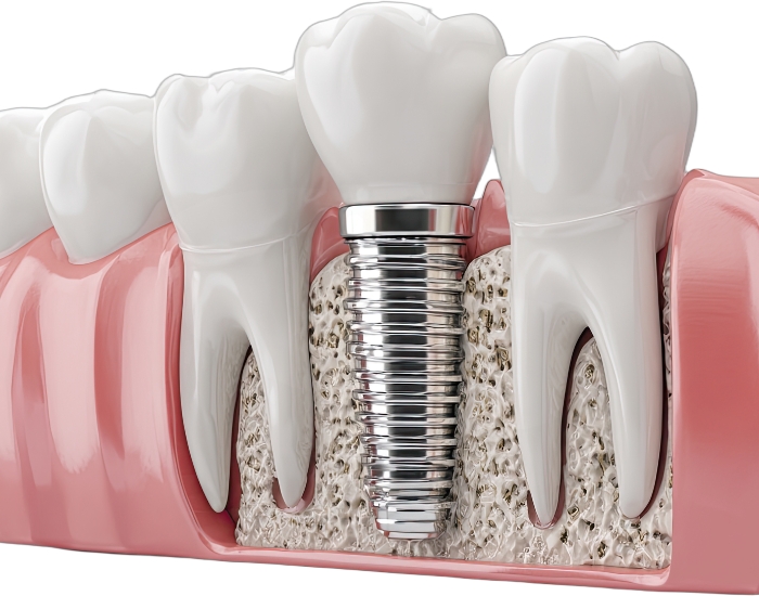 Affordable Dental Implants in Katy, TX: Your Perfect Smile at a Price You Can Afford