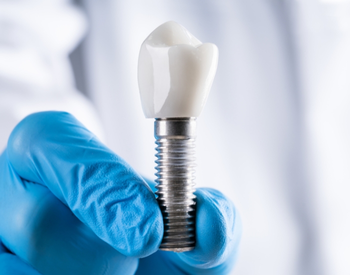 Implant dentist In houston For Affordable Implant plan