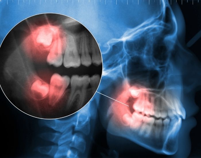 wisdom teeth removal