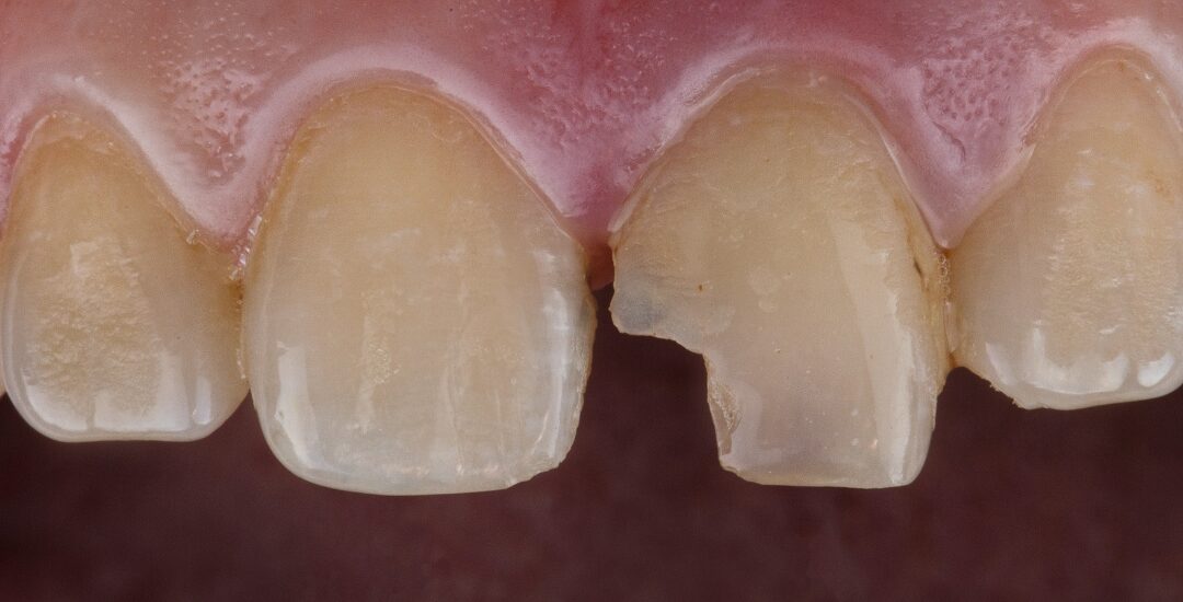 How to Fix a Chipped Front Tooth: Emergency Dental Options