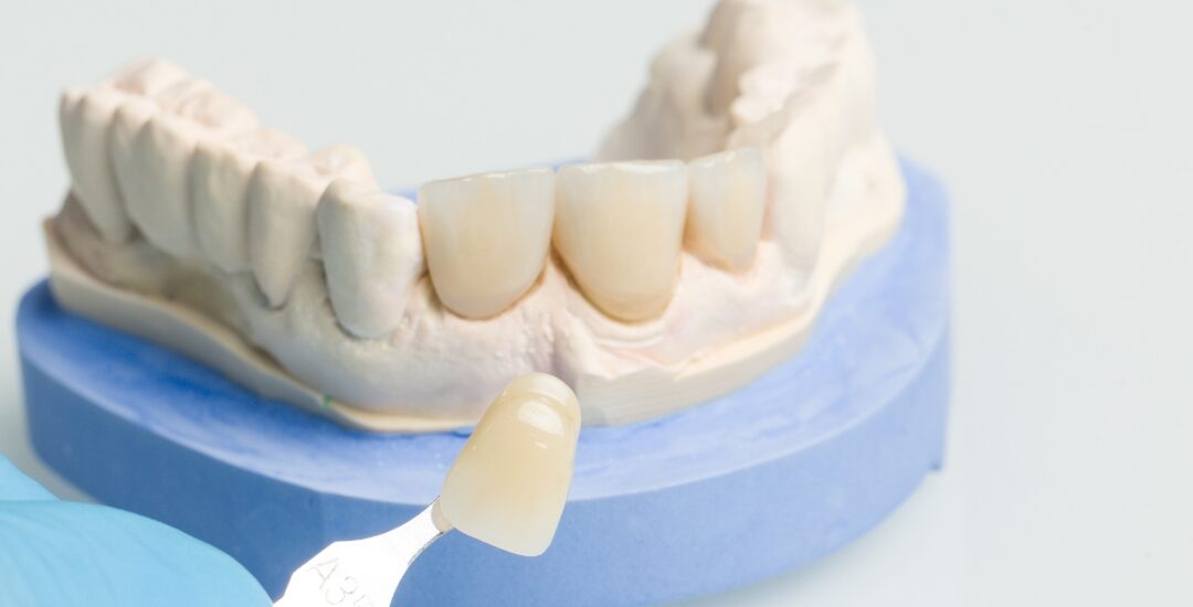 Tooth Pain After Crown Fell Off: What to Do and When to See an Emergency Dentist