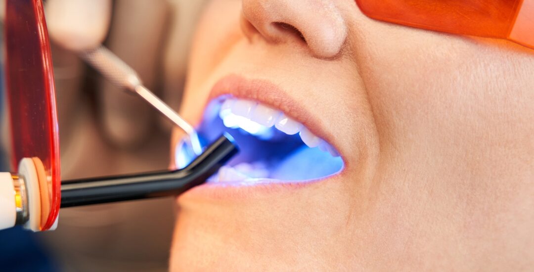 Dental Filling Fell Out? What to Do in an Emergency