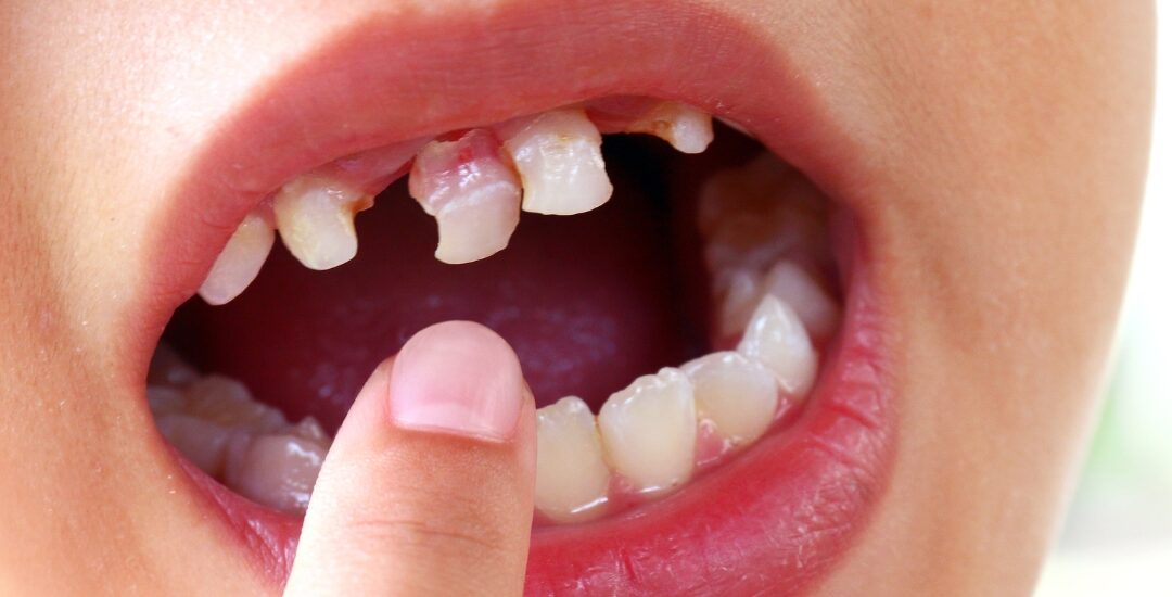 Tooth Knocked Out? What to Do Before Seeing an Emergency Dentist