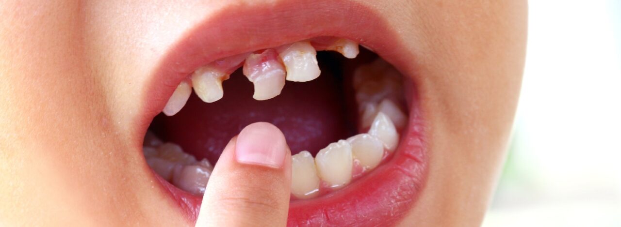 Tooth Knocked Out? Emergency Dentist Tips & Fast Care | Walk-In Dental ...