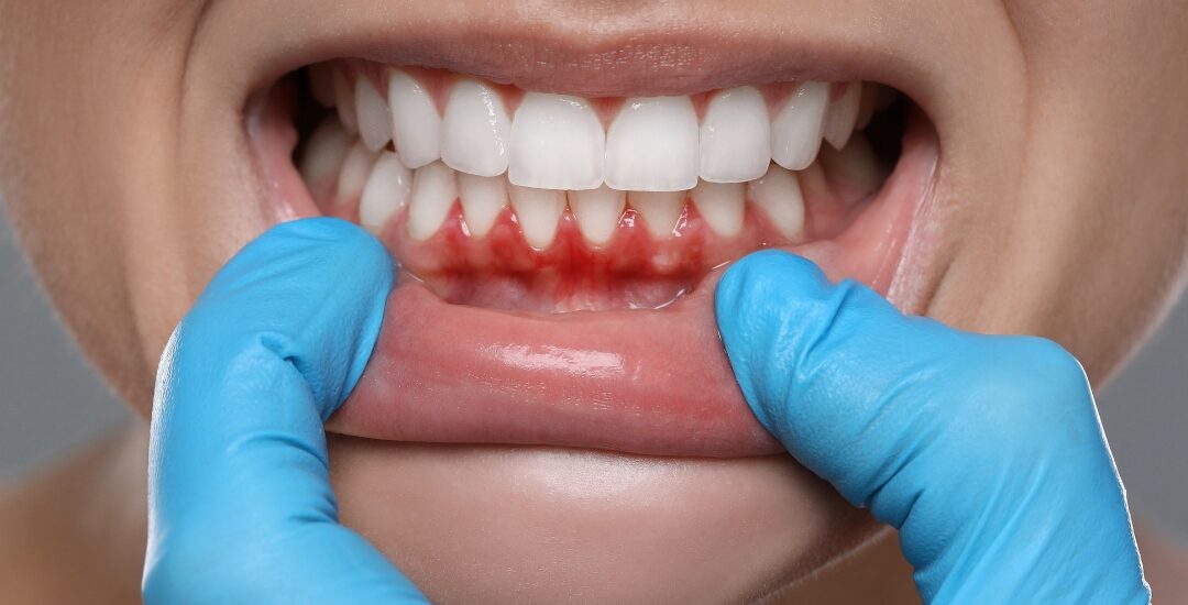 Effective Gum Infection Treatment: How to Restore Your Oral Health