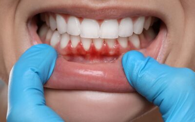 Effective Gum Infection Treatment: How to Restore Your Oral Health