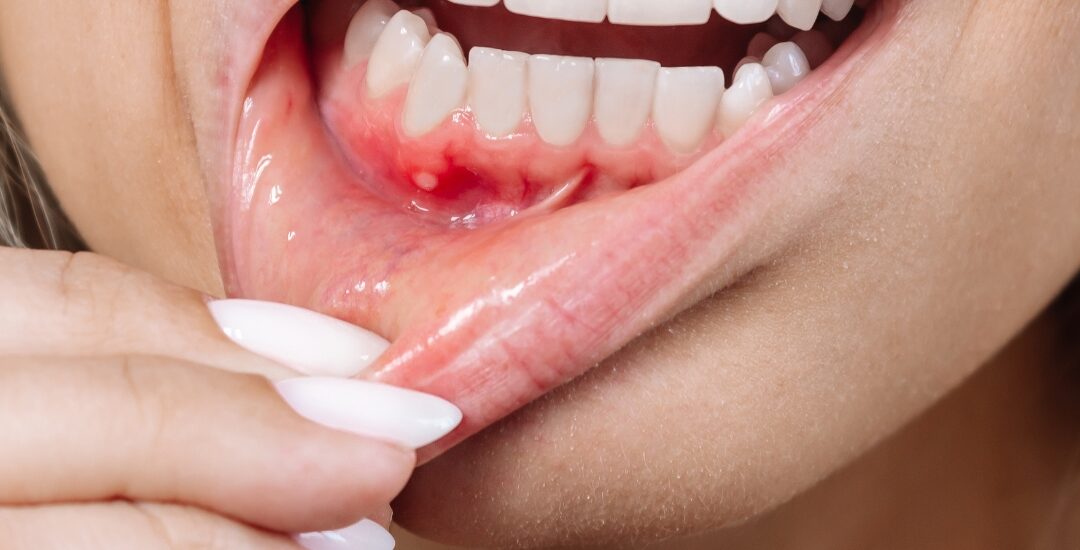 Dental Care for Swollen Gums and Jaw: What You Need to Know