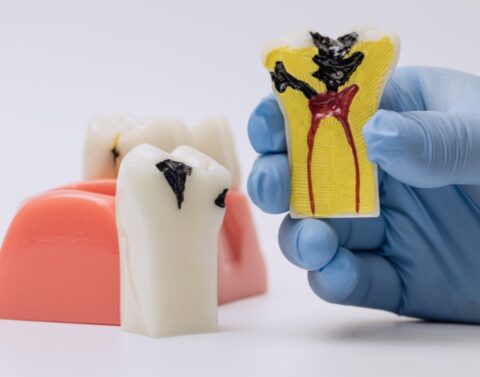 Exposed Tooth Nerve Archives | Walk-In Dental Clinic