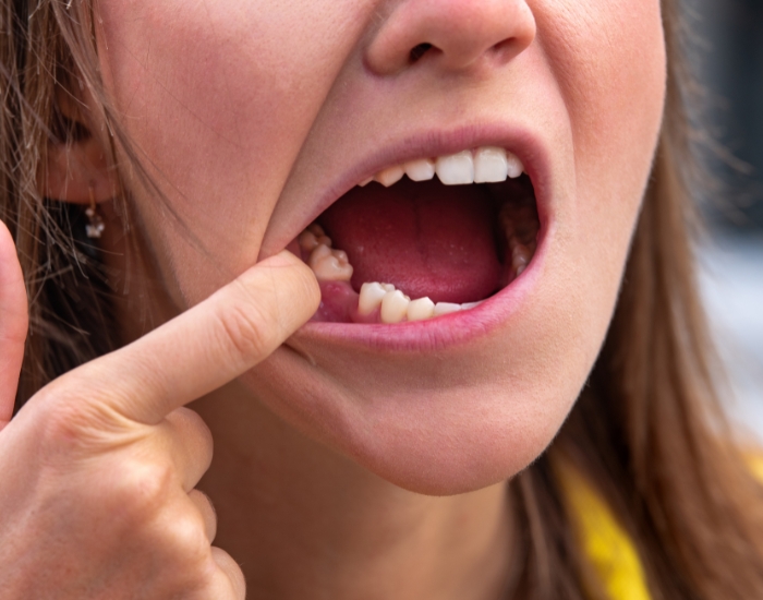 Wisdom Tooth Infection Symptoms and Treatment