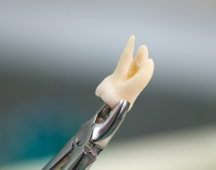 Can I Walk In for a Tooth Extraction Without an Appointment?