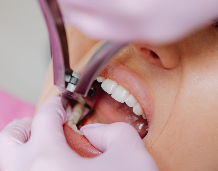 Emergency Tooth Extraction Near Me – What You Need to Know