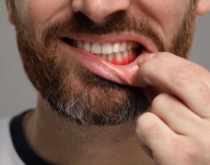 Gum Abscess Pain: Signs of Infection and Treatment Options