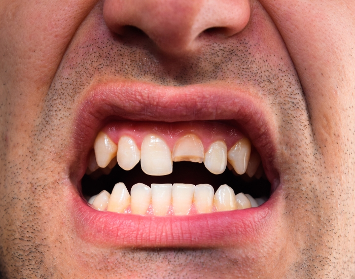 Upper Lateral Incisor Tooth: Function, Problems, Symptoms, and Treatment Options