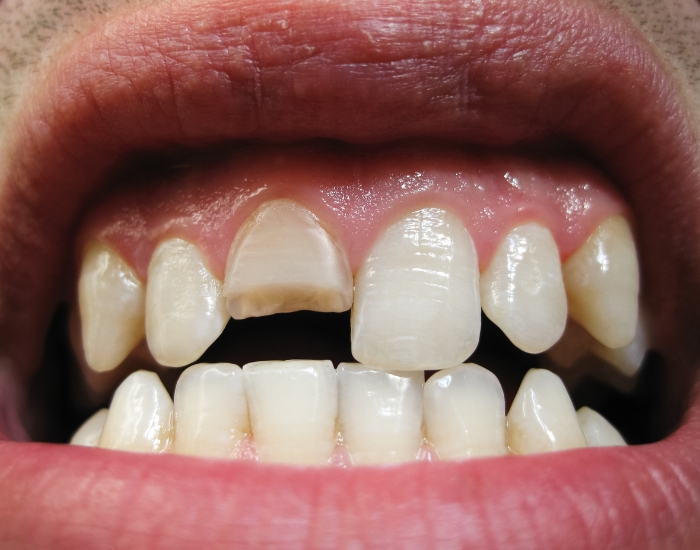 Front Incisor Chipped Tooth: Causes, Care, and Treatment Options