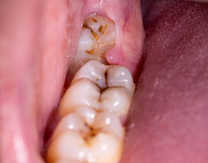 Wisdom Tooth Third Molar: Pain, Problems & Treatment Guide