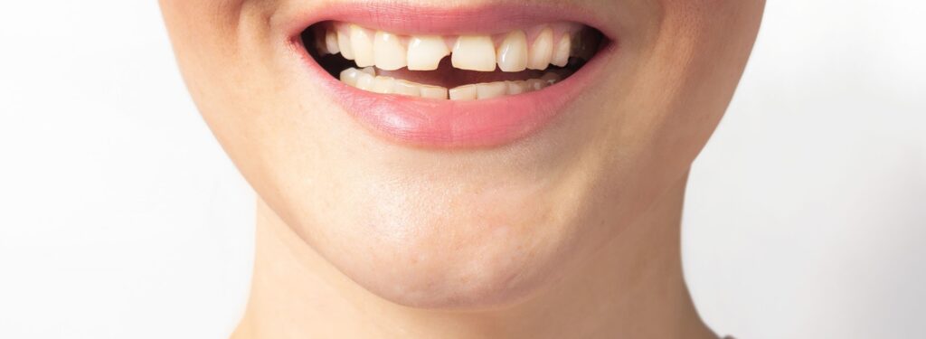 Broken tooth dental emergency treated same day in Katy, TX