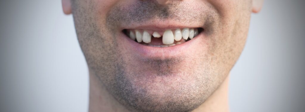 Cracked tooth causing pain, examined by an emergency dentist in Katy