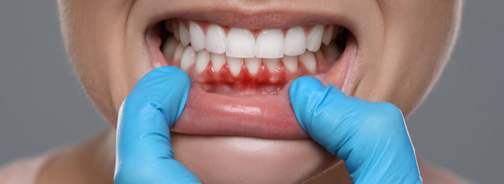 Gum Infection Treatment