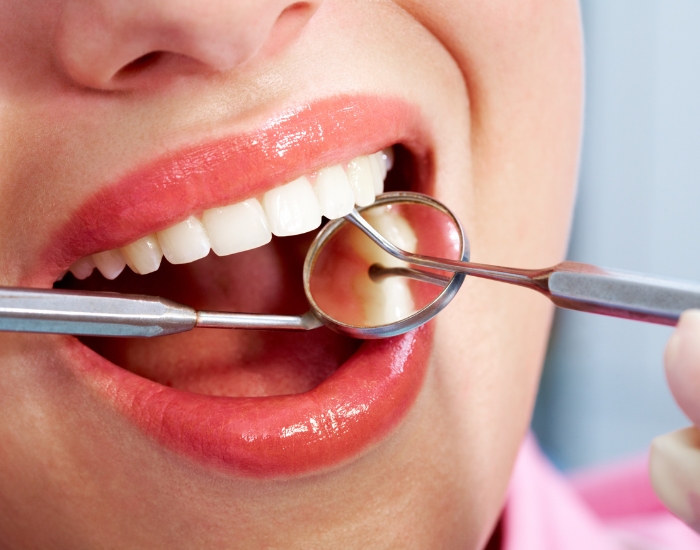 Signs You Need an Emergency Dental Extraction