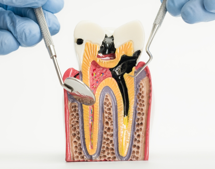Tooth Nerve Pain – Causes & Treatment Options
