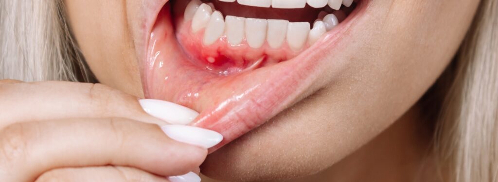 Dental Care for Swollen Gums and Jaw