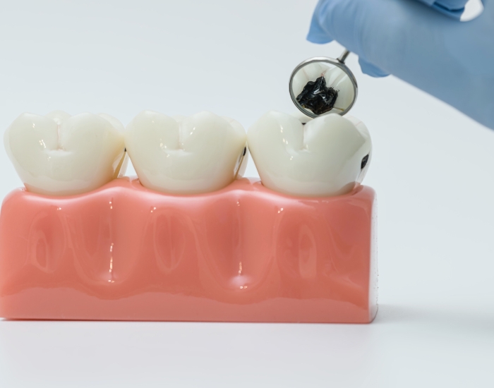 Tooth Decay Pain – Signs, Causes & Treatment