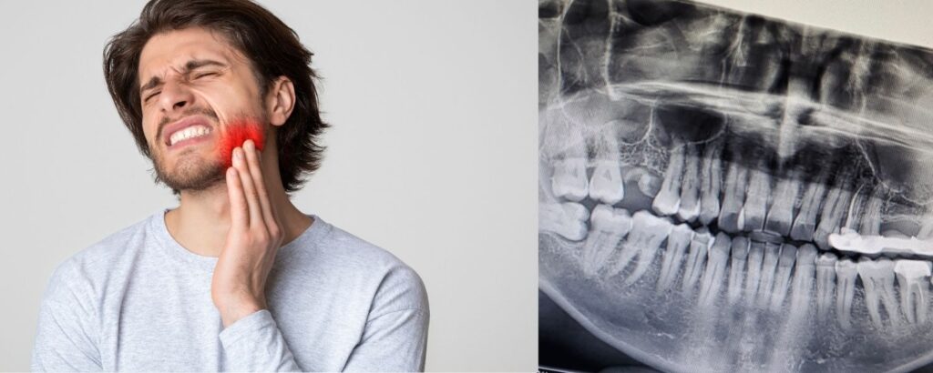 Patient with wisdom tooth pain seeking same-day removal in Katy, TX